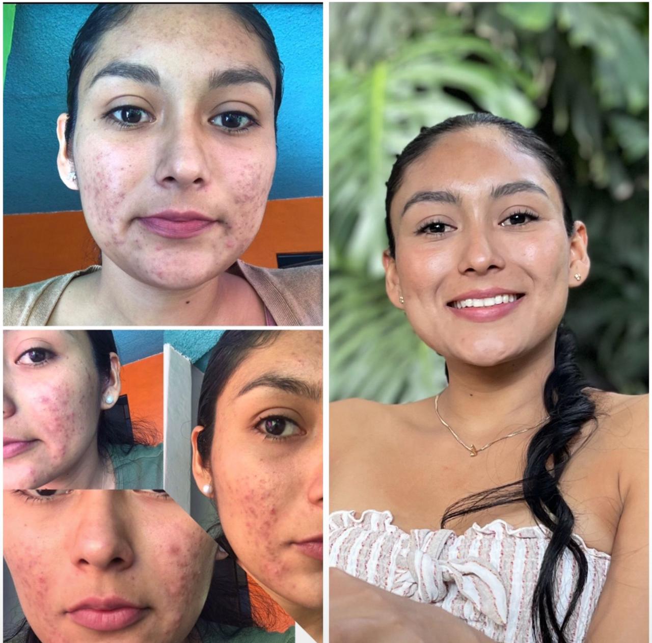 Antes y después piel rostro